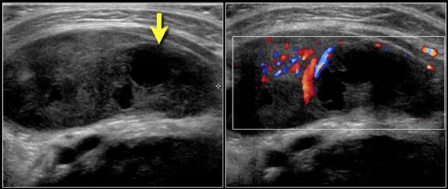 Two-year-old boy with a progressive swelling in the neck. No effect of antibiotics. An atypical Mycobacterium infection (avium) was confirmed. The anechoic parts (arrow) in the node are often seen in atypical Mycobacteria infection.