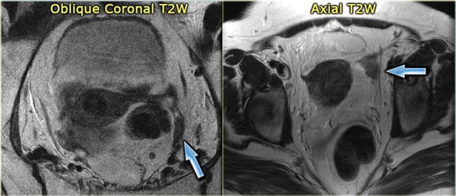 LEFT: Postmenopausal woman. The ovary is a T2 dark tissue clump near the proximal end of the round ligament.RIGHT: T2 dark left ovary devoid of follicles. It is a bit prominent, but is still likely to be normal