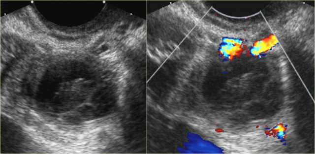 Hemorrhagic cyst with a clot mimicking a neoplasm. Notice absence of flow and good through-transmission