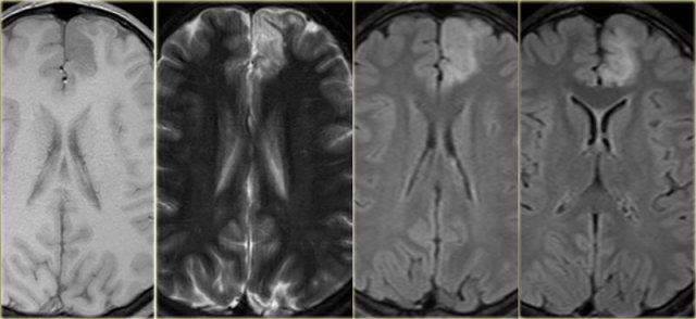 Focal cortical dysplasia. T1WI, T2WI and FLAIR.