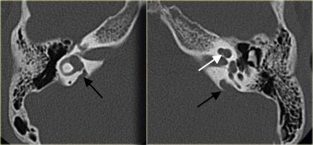 Large vestibular aqueduct bilaterally (black arrows). The bony modiolus is not visible (white arrow).