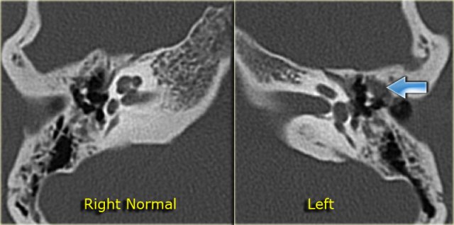 Cholesteatoma: 20-year old woman with recurrent otitis. Granulations on left ear drum. Soft tissue mass between ossicular chain and lateral tympanic wall, which is eroded. Right side for comparison.