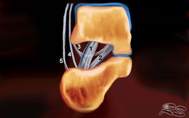 Schematic drawing in a coronal view of the right sinus tarsi. Displayed are the course and attachment sites of the cervical ligament (1); the interosseous talo- calcaneal ligament (2); and the medial (3), intermediate (4), and lateral (5) roots of the inferior extensor retinaculum.