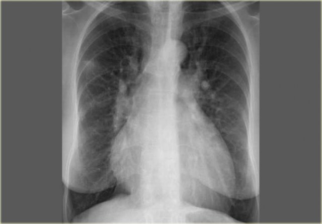 Pulmonary hypertension in a patient with partially anomalous pulmonary venous return.