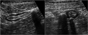 Sigmoid diverticulosis in two asymptomatic patients. The fecalith-filled diverticula are recognized as strongly reflective, round structures casting an acoustic shadow and localized at the outer contour of the empty sigmoid. The thin wall of the diverticulum, consisting of mucosa only, is not separately visible.