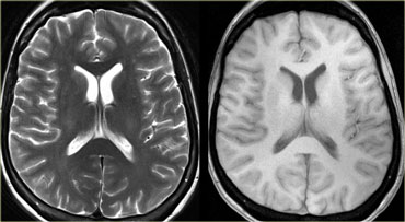T2WI and PDWI in a patient with sudden onset of neurological symptoms.