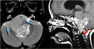 Ependymoma with extension to the prepontine area (blue arrows) and into the foramen magnum (red arrow).