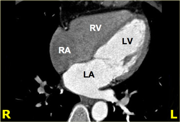 4-chamber view. RA=right atrium, RV=right ventricle, LA=left atrium, LV=left ventricle
