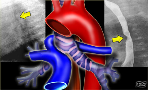 Aberrant left pulmonary artery: aberrant artery extends between trachea and esophagus indenting both (arrows)