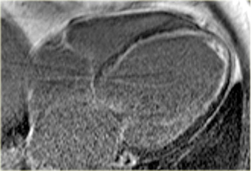 Late enhancement image in a patient with ischemic dilated cardiomyopathy . Note the characteristic subendocardial enhancement.