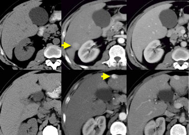 NECT, arterial and portal venous phase in a patient with Hepatitis C with two lesions in the liver (arrows).