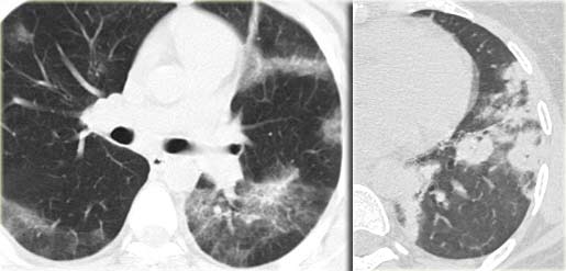 Chronic eosinophilic pneumonia (left)  versus Organizing pneumonia (right)