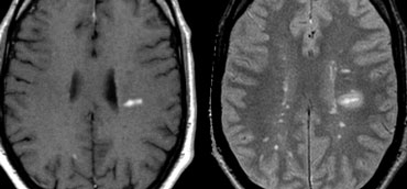 LEFT: Typical Dawson finger with enhancement on T1WI. RIGHT: Multiple lesions and edema around enhancing lesion on T2WI.