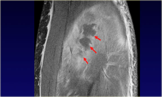 T1-weighted image with fatsat post contrast Fluid collections within the enhancing muscle in a patient with pyomyositis