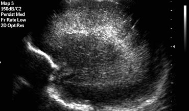 Sagittal image of a child with PVL grade 1