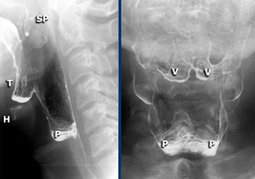 LEFT: Lateral view during singing aaa. Hyoid (H) and tongue base (T) move anteriorly. Left and right  pyriform sinuses are projected on top of each other. Tip of soft palate (SP) is seen.  RIGHT: Valleculae (V) and pyriform sinuses (P).