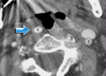 Impression of the oropharynx by an elongated internal carotid artery (blue arrow.). Compare to the position of the carotid artery on the left