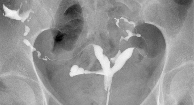 HSG showing abnormal uterine cavity. Differentiation between septate and bicorporeal uterus is not possible