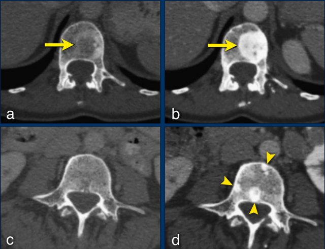 The sclerotic bone lesions in b and d are not new metastases but an osteoblastic reaction.  Courtesy Els van Persijn van Meerten.