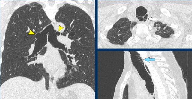 Tracheobronchomegaly in a 59 y.o female, showing a severely dilated trachea and mainstem bronchi, with evident posterior diverticulosis.