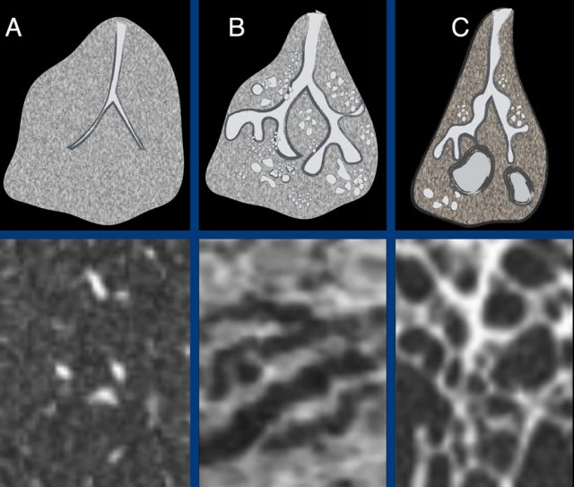 The ongoing process of honeycombing formation. There is a spectrum ranging from normal lung tissue (A), through distortion of the secondary lobule with traction bronchiolectasis (B), to end stage cyst formation (C).