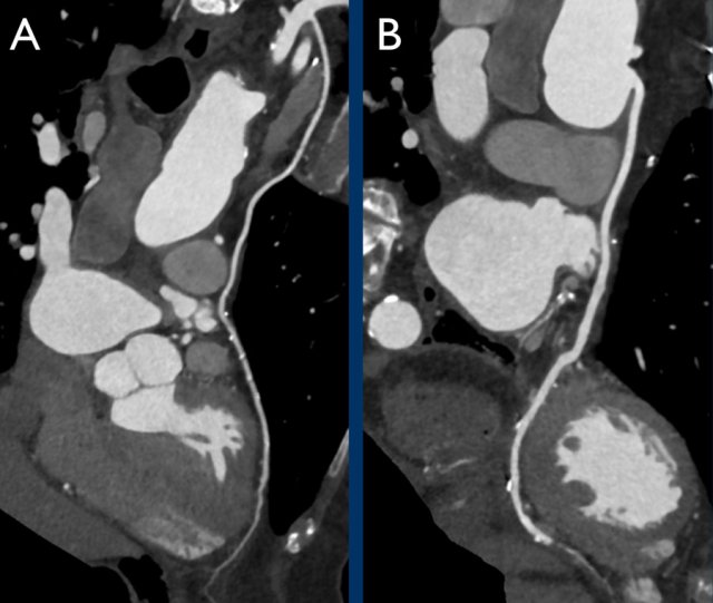 A. example of LIMA-LAD without stenosis. B.example of SVG to posterior descending artery also with no stenosis in the graft. NB: there is a severe stenosis distal to the SVG, which is the bypassed stenosis and as of that is not considered for CAD-RADS classification.