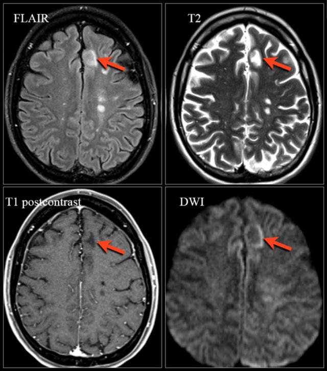 Natalizumab-associated PML. Images were kindly provided by Bénédicte Quivron CH Jolimont, La Louvière, Belgium