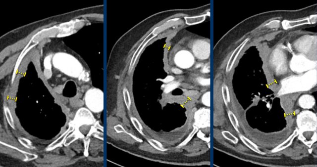 Measurements of the tumour thickness perpendicular to the chest wall or mediastinum in two positions at three different levels.