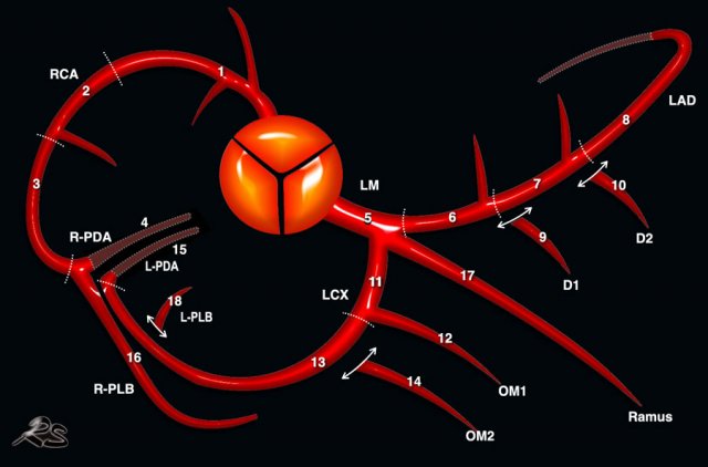 Society of Cardiovascular Computed Tomography (SCCT) coronary segmentation diagram (15). Click to enlarge.