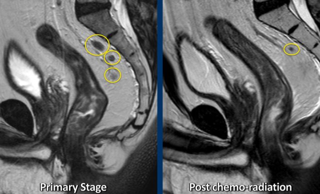 Example of a patient with several irregularly enlarged cN+ nodes at primary staging. After chemoradiotherapy, most nodes have disappeared and only a small node of < 5 mm remains, indicative of a ycN0 stage.