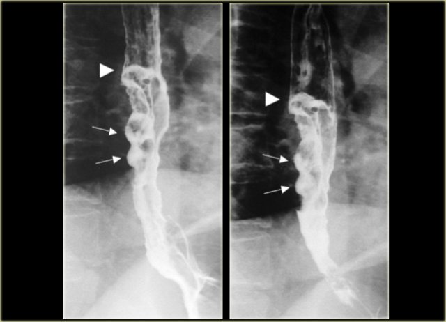 Esophageal carcinoma with ulcerations (arrows) and sharp right angle junction with esophageal wall (arrowheads)