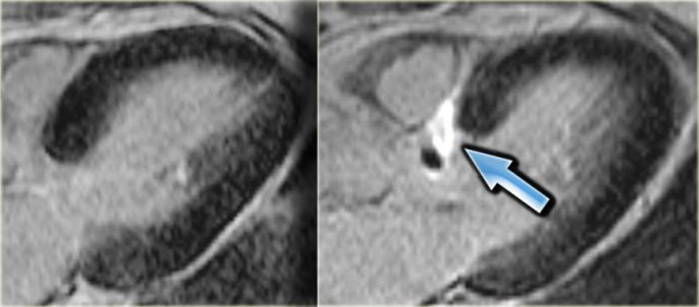 3-chamber late enhancement image before (left) and after (right) alcohol ablation. Note the transmural infarction of the basal septum (arrow).