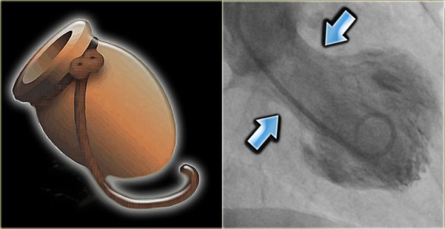 LEFT: Octopus pot RIGHT: left ventricle angiogram in a patient with Tako tsubo cardiomyopathy. There is only contraction of the basal segments (blue arrows) and the mid- and apical segments balloon.