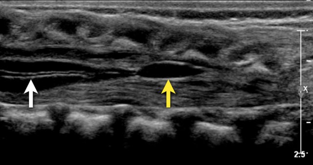 Two-week-old girl with a sacral simple. There is a slight hydromyelia (white arrow) and a cyst in the filum terminale (yellow arrow), both are normal variants.